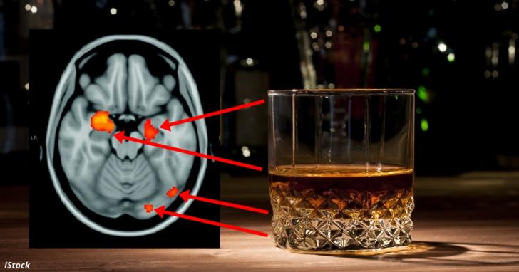 Даже умеренное потребление алкоголя вызывает атрофию мозга! Новое исследование