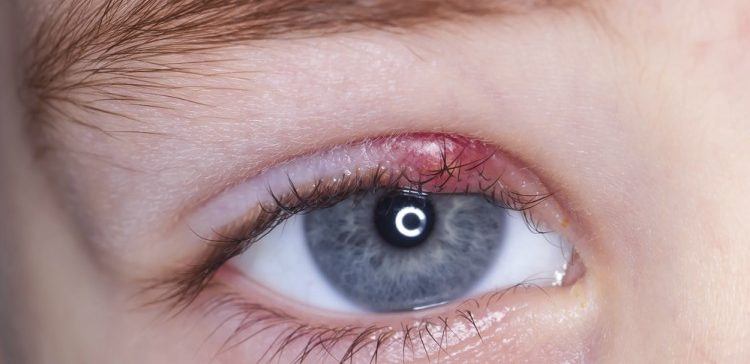 11 полезных средств  для лечения Ячменя  на глазах!