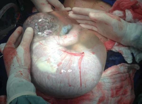 Ребенок родился внутри неповрежденной оболочки