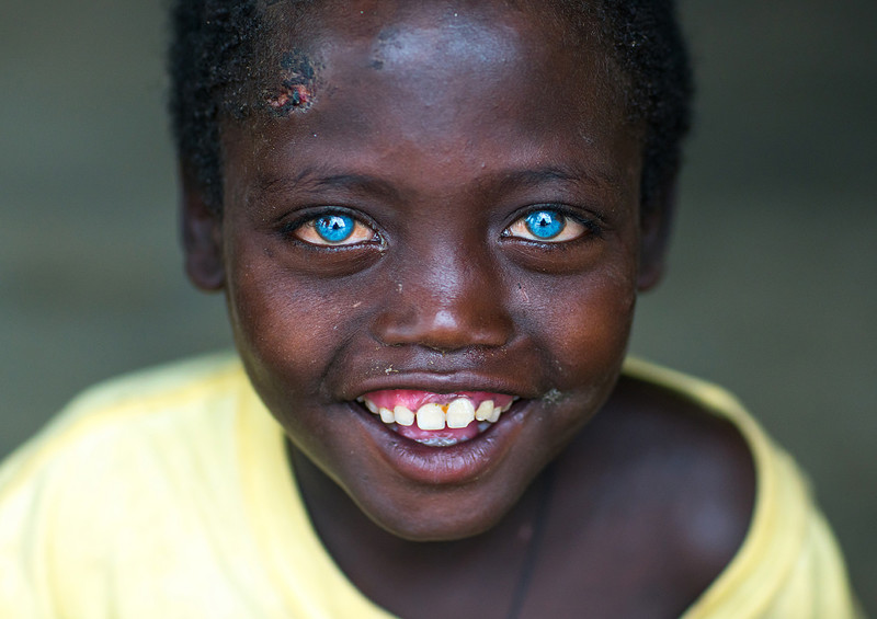 Невероятно красивые глаза африканского мальчика, подаренные ему болезнью
