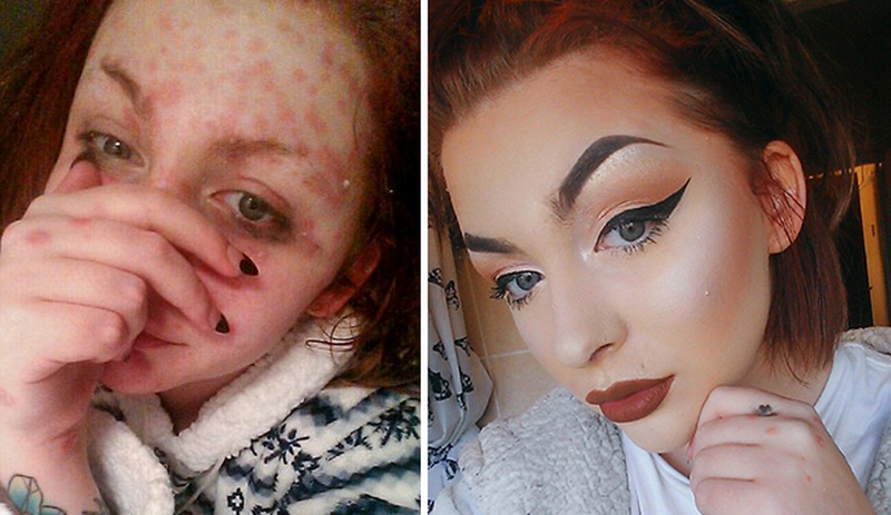  Чудеса макияжа: девушка с «кожей чешуей» вдохновляет больных псориазом волшебными преображениями