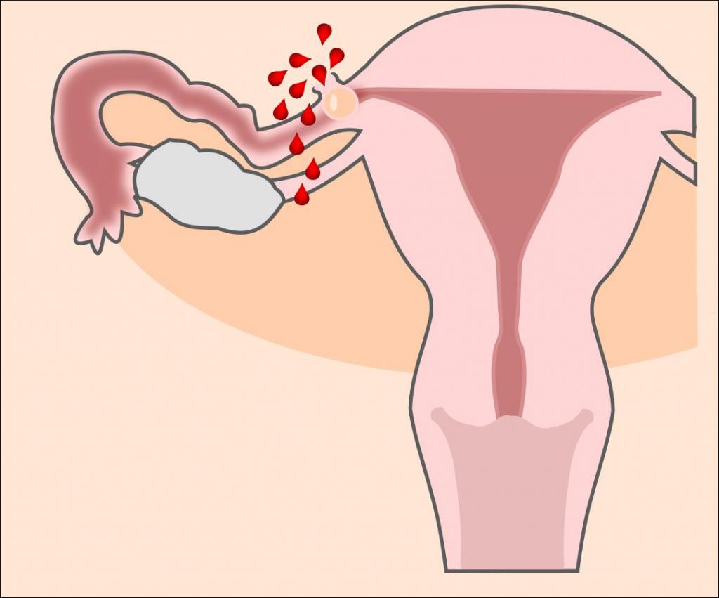 Внематочная беременность: признаки и симптомы на ранних сроках
