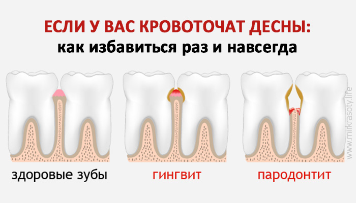 Если у вас кровоточат десны при чистке зубов, вот что стоит знать!