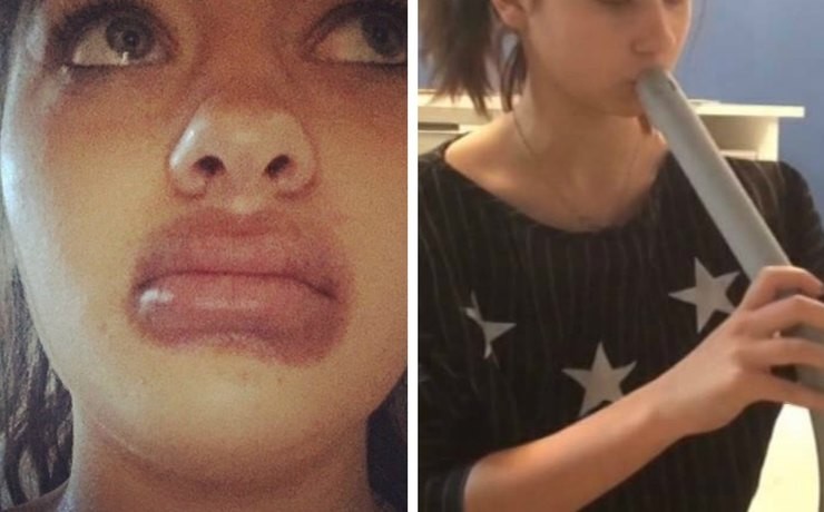 19 летняя ростовчанка попыталась увеличить губы пылесосом